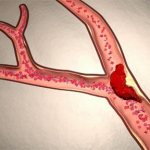 последствия ОНМК