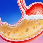 Increased stomach acidity