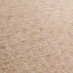 Increased dryness of the skin