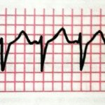 Предсердная форма нарушения