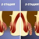 Without treatment, hemorrhoids progress