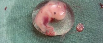 Причиной прерывания беременности на ранних сроках может послужить сифилис.