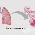 Признаки бронхопневмонии