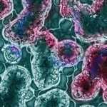 signs and symptoms of leukemia