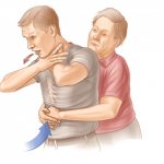 Признаки обструкции дыхательных путей