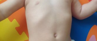 signs of rickets at 8 months