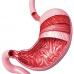 Signs of a stomach ulcer