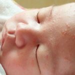 прыщики на лице у новорожденного в 1-2 месяц с белой головкой