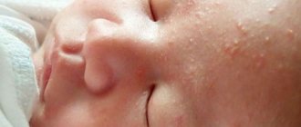 pimples on the face of a newborn at 1-2 months with a white head