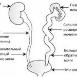 Пузырно-мочеточниковый рефлюкс