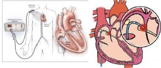 Радиочастотная абляция