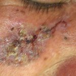 Рак кожи - что это такое