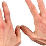 Irritant contact dermatitis