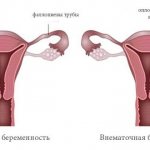 development of ectopic pregnancy