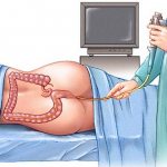 Sigmoidoscopy