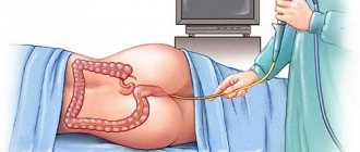 Sigmoidoscopy