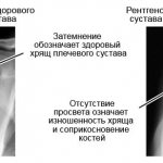 X-ray of a healthy shoulder and one affected by arthrosis