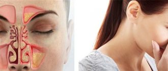 Риносинусит