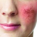 Розацеа появляется по разным причинам