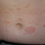 Розовый лишай – лечение таблетками и мазью: ТОП-17 средств