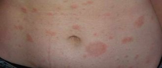 Pityriasis rosea - treatment with tablets and ointment: TOP-17 remedies