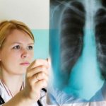 Саркоидоз легких – как выявить и лечить болезнь на всех стадиях?