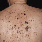 себорейный кератоз лечение народными средствами