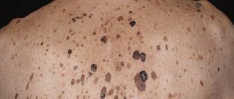 seborrheic keratosis treatment with folk remedies