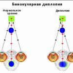 Схема бинокулярной диплопии