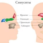 Schematic representation of sinusitis