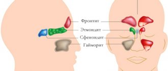 Schematic representation of sinusitis