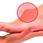 Шишка на ноге