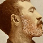 Сикоз бороды