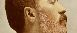 Sycosis of the beard