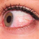 симптомы отека глазго века