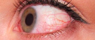 symptoms of swelling of the eyelid