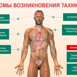 Symptoms of tachycardia
