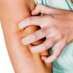 Симптомы ветрянки