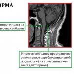 Синдром Арнольда Киари