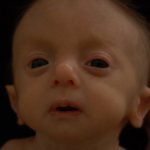 Patau syndrome in children: karyotype, symptoms, signs