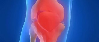 synovitis of the knee joint