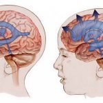 смешанная гидроцефалия