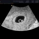 Ultrasound image at 5 weeks of pregnancy