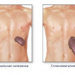 Спленомегалия