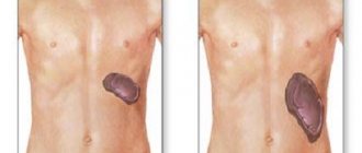 Спленомегалия