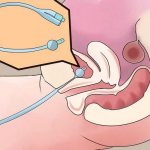 Cervical stimulation