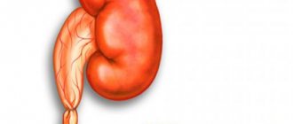 Ureteral stricture