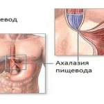 narrowing of the esophagus