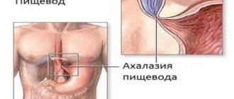 narrowing of the esophagus