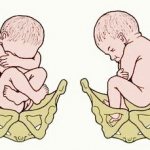 Breech presentation of the fetus: causes, childbirth, exercises, photos